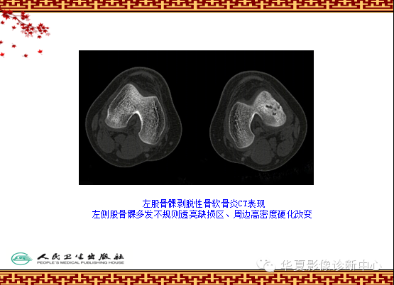 骨缺血坏死与骨梗死 的影像诊断