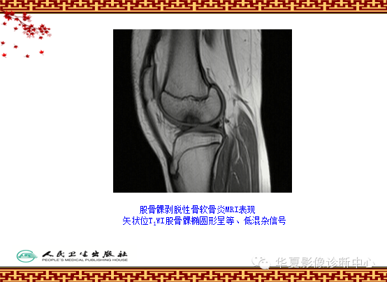 骨缺血坏死与骨梗死 的影像诊断