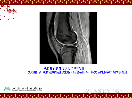骨缺血坏死与骨梗死 的影像诊断