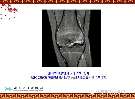 骨缺血坏死与骨梗死 的影像诊断