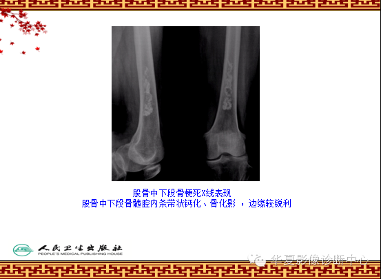 骨缺血坏死与骨梗死 的影像诊断