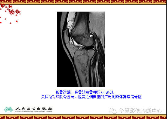 骨缺血坏死与骨梗死 的影像诊断