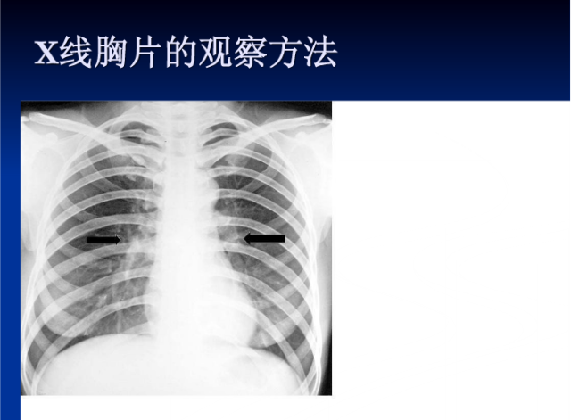 肺部X线诊断