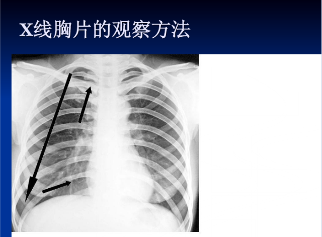 肺部X线诊断