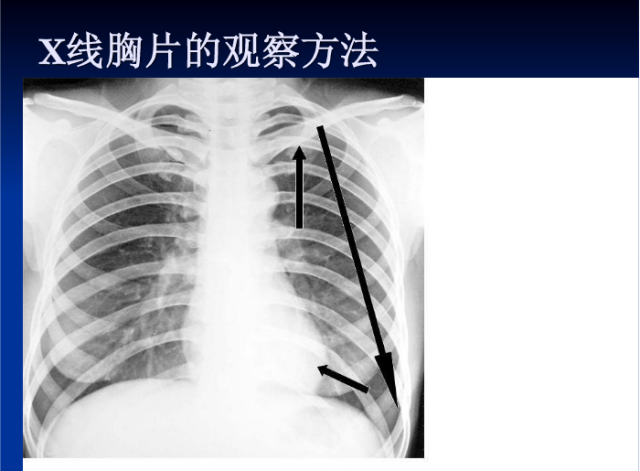 肺部X线诊断