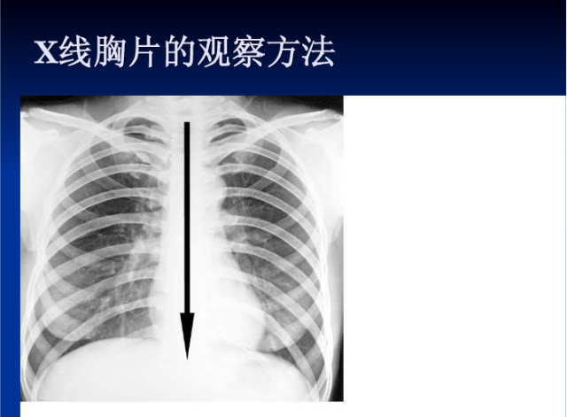 肺部X线诊断