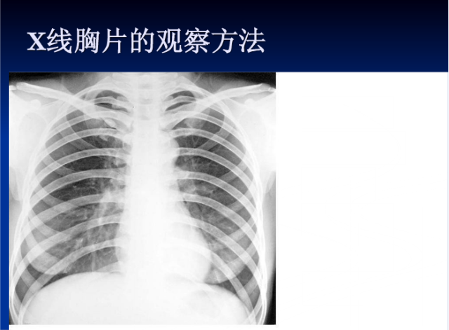 肺部X线诊断
