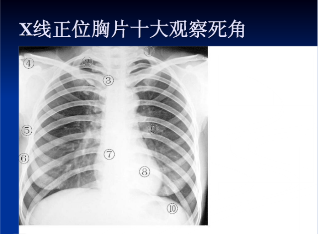 肺部X线诊断