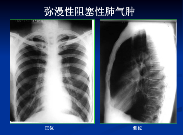 肺部X线诊断