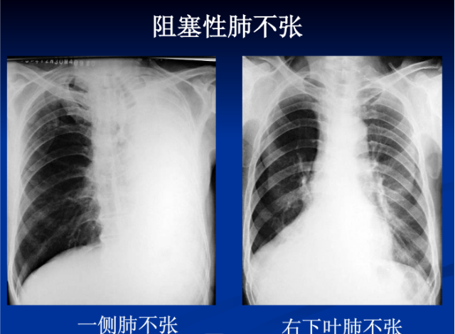 肺部X线诊断