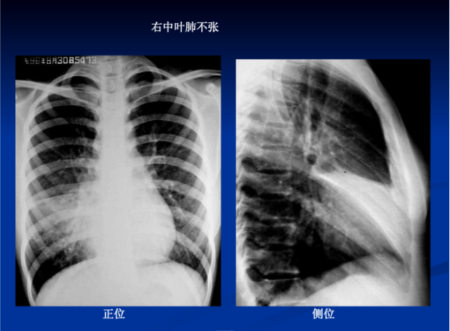 肺部X线诊断