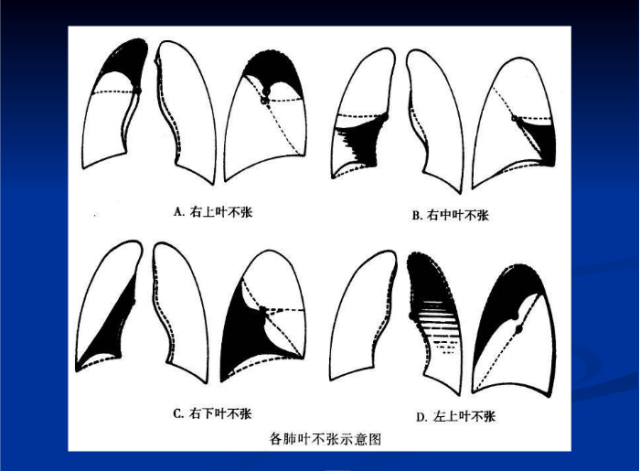 肺部X线诊断