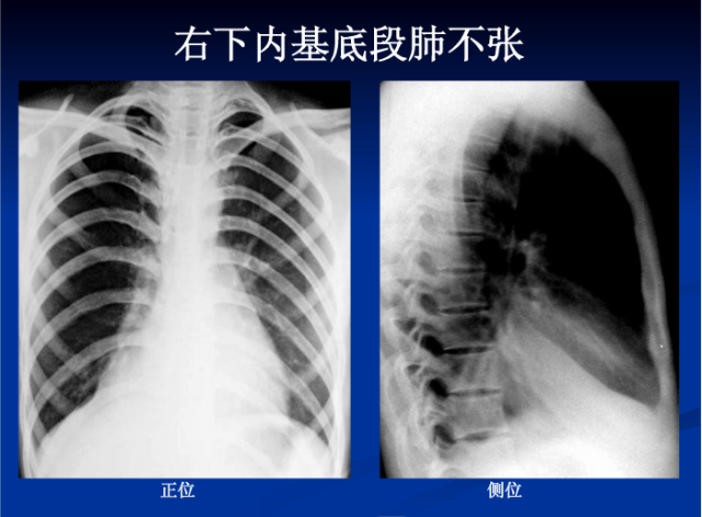 肺部X线诊断