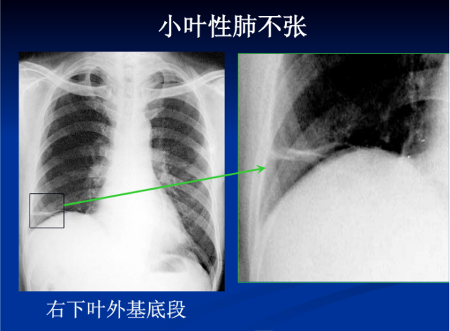 肺部X线诊断