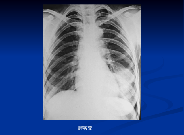 肺部X线诊断