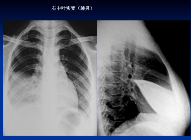 肺部X线诊断