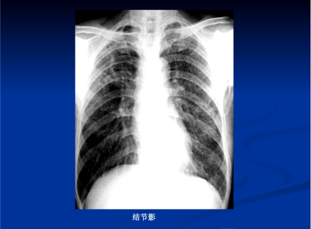 肺部X线诊断