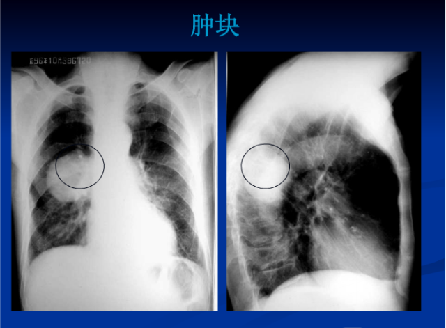 肺部X线诊断