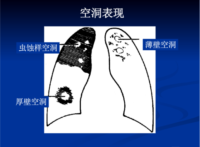 肺部X线诊断