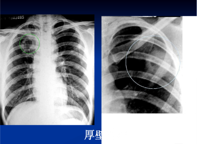 肺部X线诊断