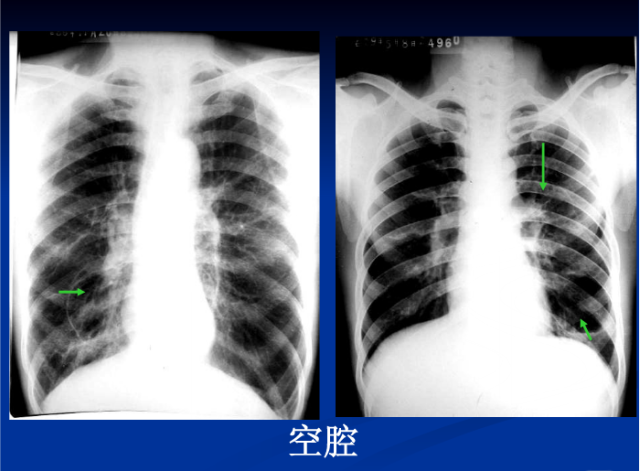 肺部X线诊断