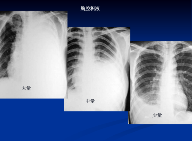 肺部X线诊断