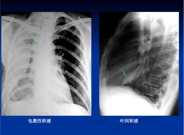 肺部X线诊断