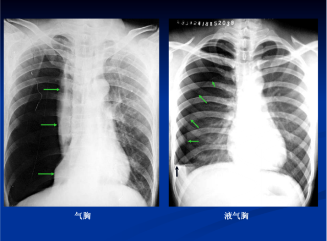 肺部X线诊断