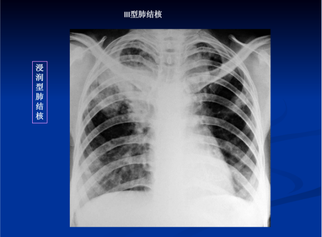 肺部X线诊断