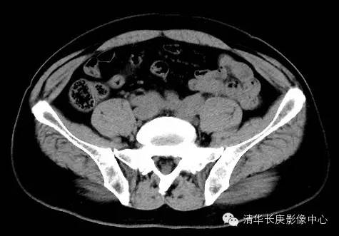 【病例学习】腹膜后纤维化一例CT诊断 【病例学习】腹膜后纤维化一例CT诊断