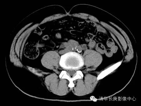 【病例学习】腹膜后纤维化一例CT诊断 【病例学习】腹膜后纤维化一例CT诊断