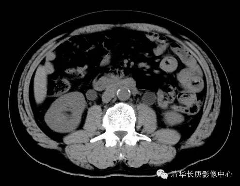【病例学习】腹膜后纤维化一例CT诊断
