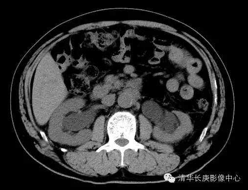 【病例学习】腹膜后纤维化一例CT诊断 【病例学习】腹膜后纤维化一例CT诊断