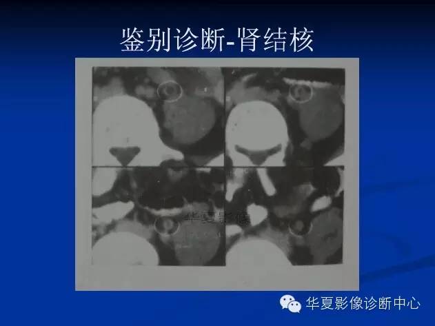 【病例学习】髓质海绵肾的CT表现 【病例学习】髓质海绵肾的CT表现