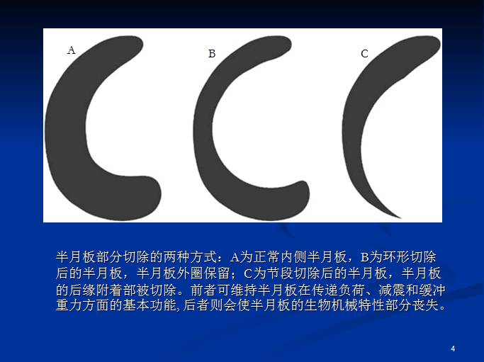 半月板和前交叉韧带术后的MRI评价