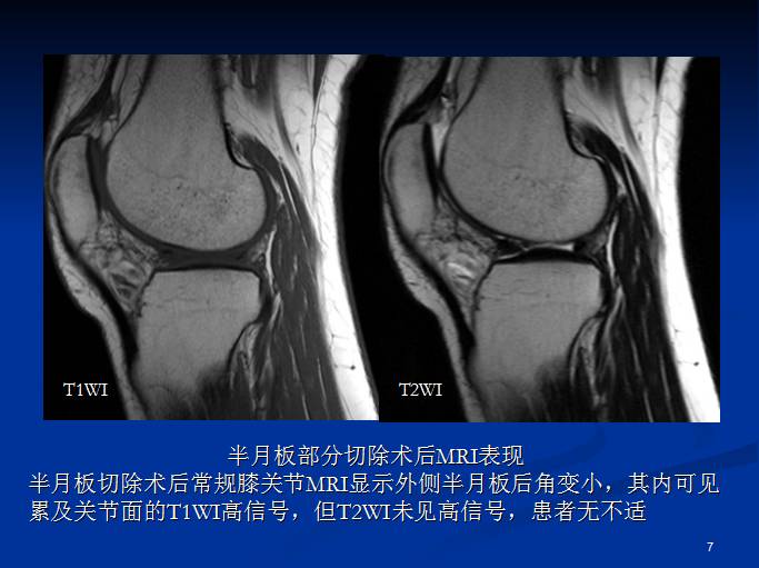 半月板和前交叉韧带术后的MRI评价