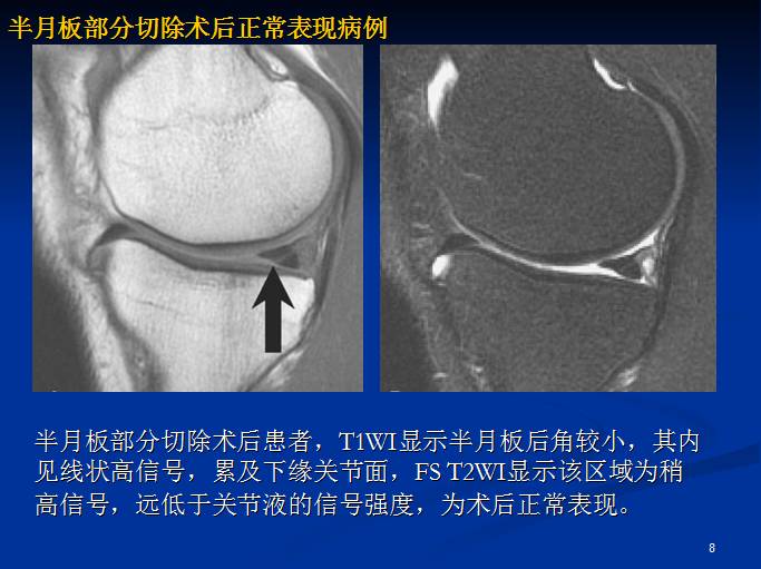 半月板和前交叉韧带术后的MRI评价