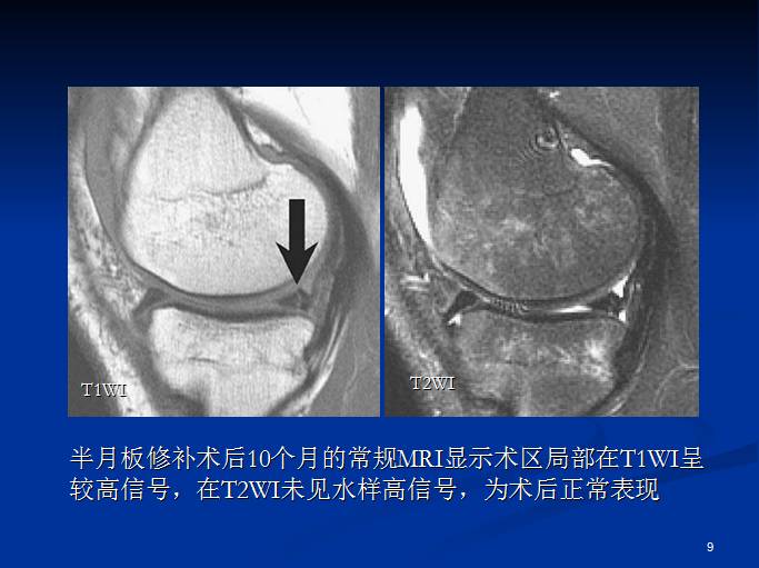 半月板和前交叉韧带术后的MRI评价