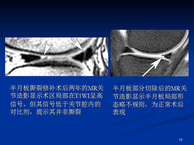 半月板和前交叉韧带术后的MRI评价