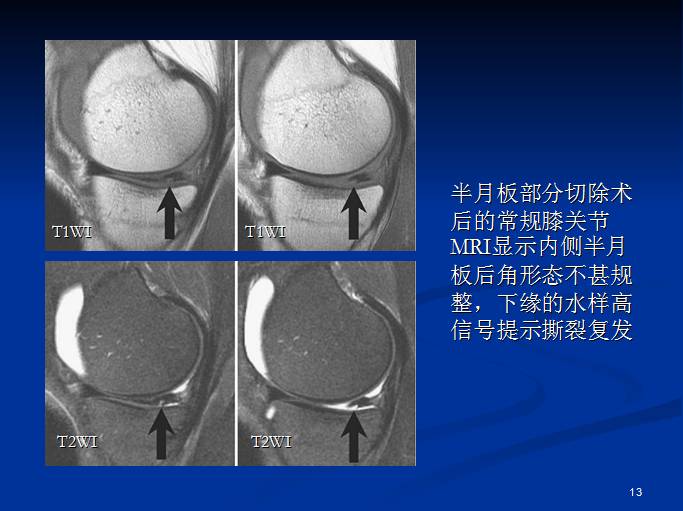 半月板和前交叉韧带术后的MRI评价