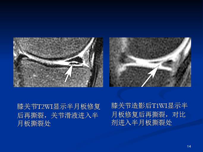 半月板和前交叉韧带术后的MRI评价