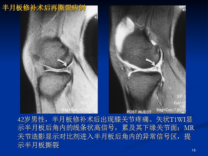 半月板和前交叉韧带术后的MRI评价