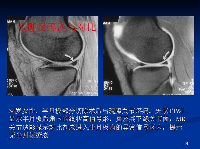 半月板和前交叉韧带术后的MRI评价