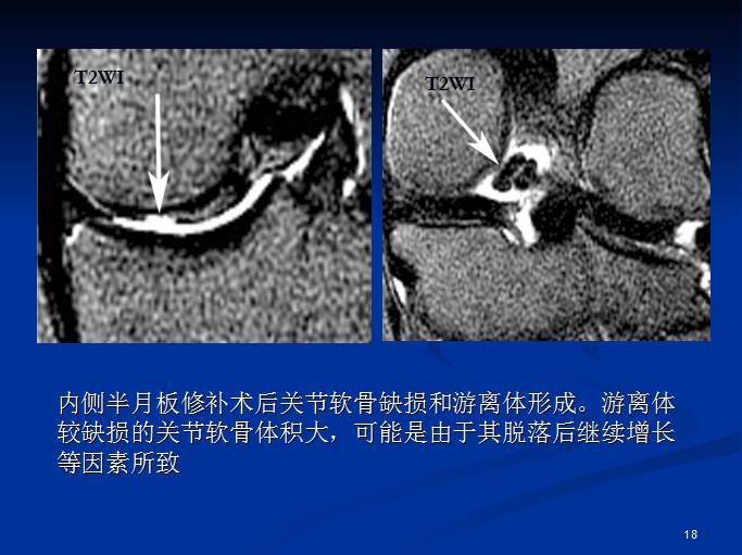 半月板和前交叉韧带术后的MRI评价