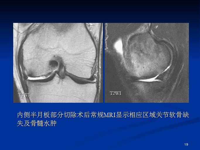半月板和前交叉韧带术后的MRI评价