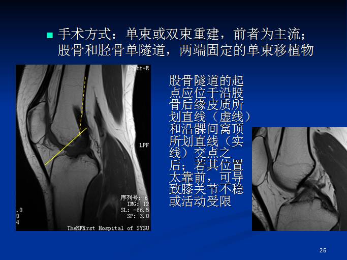 半月板和前交叉韧带术后的MRI评价