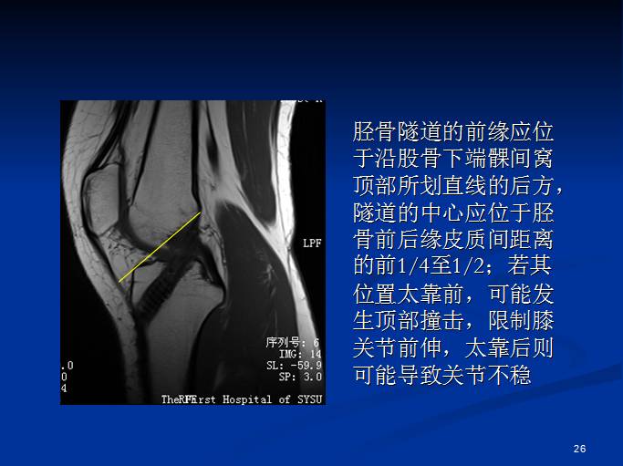 半月板和前交叉韧带术后的MRI评价