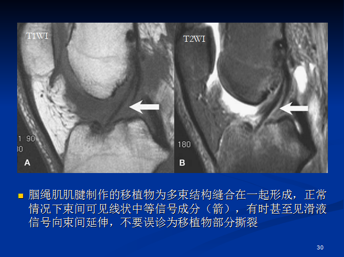半月板和前交叉韧带术后的MRI评价