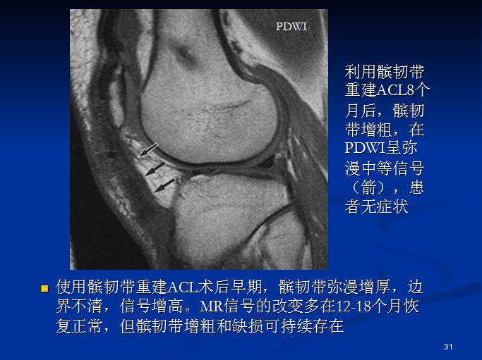 半月板和前交叉韧带术后的MRI评价