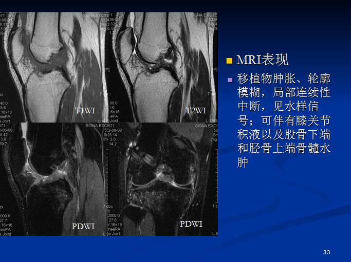 半月板和前交叉韧带术后的MRI评价